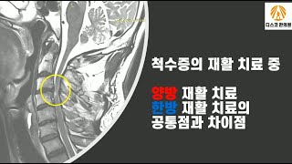 척수손상(척수증)의 재활 치료, 양방 치료에 한방 치료를 병행하면 얼마나 치료가 잘 될까?