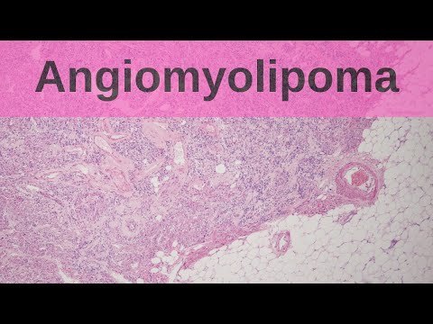 Video: Angiomyolipoma - Causes, Symptoms, Treatment