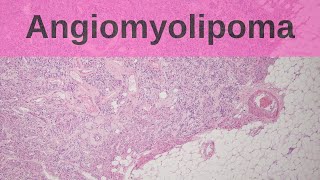 Angiomyolipoma of the kidney  Pathology mini tutorial