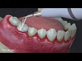 Ako prebieha čistenie zubov u dentálnej hygeničky