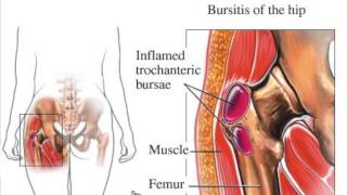 Greater Trochanteric Bursa Gtb Injection