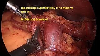 Laparoscopic Splenectomy for Massive Spleen