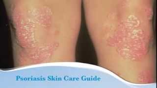 Psoriasis skin care guide