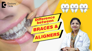 Aligners vs Braces Treatment - Which is the Best? - Dr. Divyashree Rajendra | Doctors