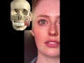 Masseter reduction simulation