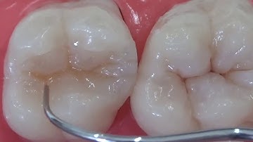 Class II restoration   Stratification technique with Tetric N family materials