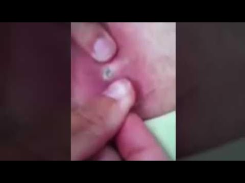 Deep Pimple Cyst Popping With Lots Of Pus 2014 All Pimples Of The