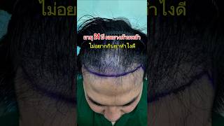 อายุ 24 ปี ผมบางด้านหน้า ไม่อยากกินยา รักษายังไงดี #อายุน้อยผมร่วง #หมอท๊อปปลูกผม