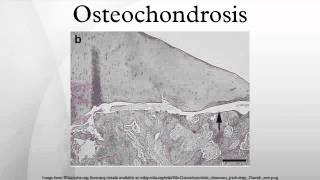 a mellkas osteochondrosisa