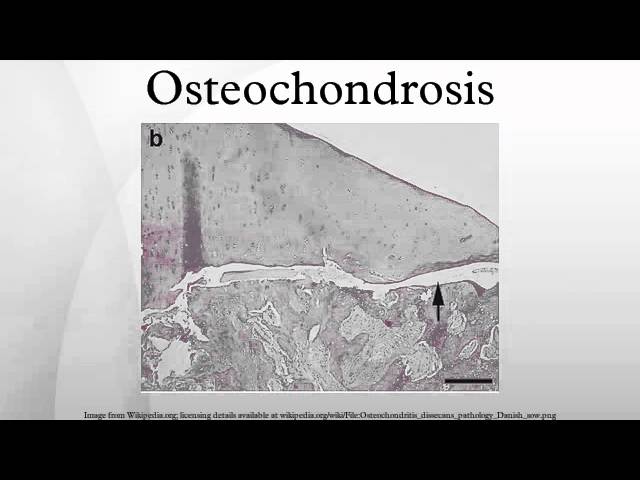 a könyökízület 1 fokozatának osteochondrosis)
