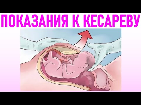 РЕАЛЬНЫЕ ПОКАЗАНИЯ К КЕСАРЕВУ СЕЧЕНИЮ | Когда делают кесарево сечение