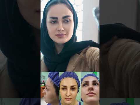 شفو الانف بعد اسبوع من عملية تجميل الانف وبعد 6 اشهر شگد اختلف