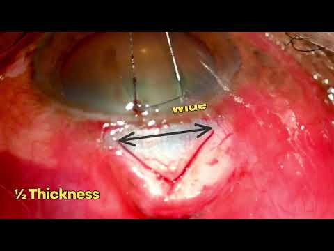 Episode 2 Trabeculectomy Series - Mitomycin C Application & Scleral Flap Creation