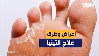 الدكتور هاني الناظر يكشف أعراض وطرق علاج التينيا