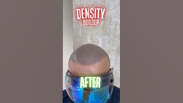 SMP heals hair transplant failures #smp #scalpmicropigmentation #scalpdots