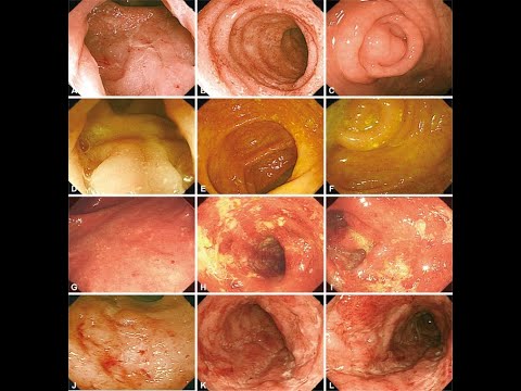 Colitis ulcerosa dieta