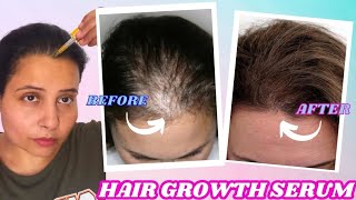 I applied this SERUM For Non Stop Triple Hair Growth &amp; Hair Density- गंजे सर में भी उगे नए बाल