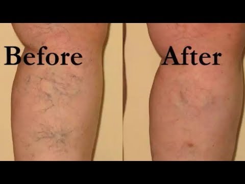 this-guy-used-apple-cider-vinegar-for-varicose-veins-testimonies-see-what-happened-next