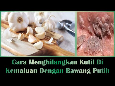 cara-menghilangkan-kutil-di-kemaluan-dengan-bawang-putih