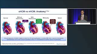 Pushing Back Against HCM: The Role of Cardiac Myosin Inhibitors