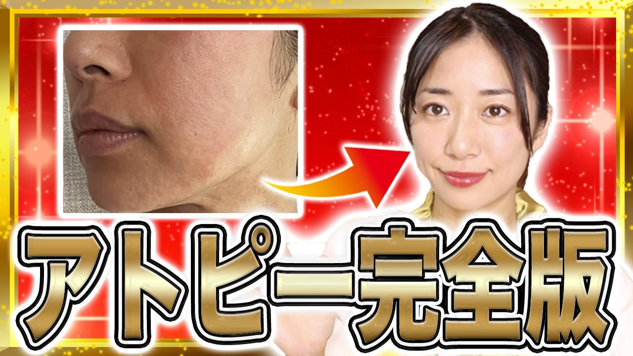 【完全版】私が重症のアトピーを改善して美肌になった方法を大公開【超有料級】