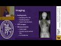 Adolescent Idiopathic Scoliosis- Current State and Controversies