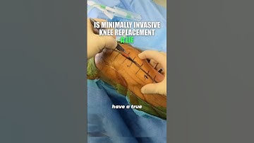 Surprising Truth About Subvastus Knee Replacement Surgery