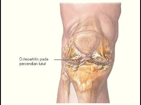 What Obat Pengapuran Di Lutut