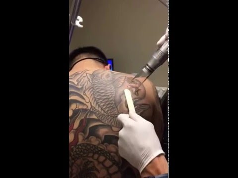 laser tattoo removal at hoboken u0026 edgewater med spas in new laser tattoo removal at hoboken u0026 edgewater med spas in new