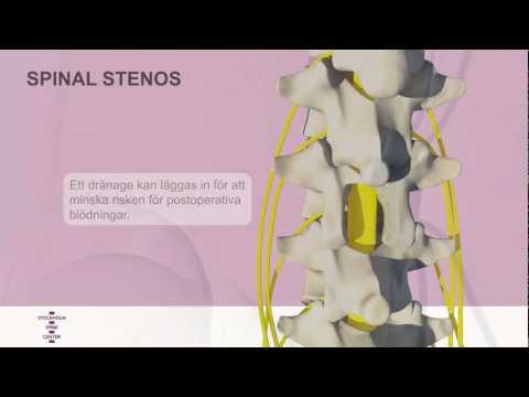 Video: Förträngning Av Ryggradskanalen Hos Hundar