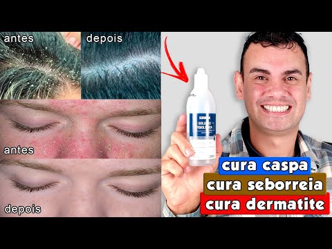 CURA CASPA, DERMATITE