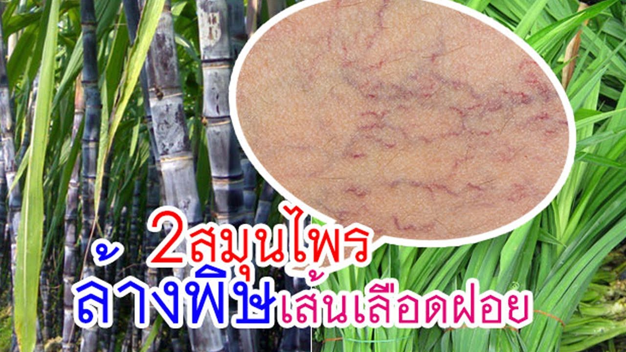 อาการ เส้นเลือด ขอ ด  New 2022  มหัศจรรย์!!สูตรล้างพิษในเส้นเลือดฝอย(Capillaries)ด้วยสมุนไพร 2 อย่างนี้  พร้อมวิธีกินที่ถูกต้อง