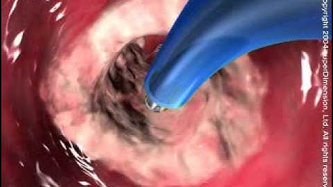 Lung Navigation System of Super Dimension, video produced by Virtual Point