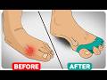 The Ultimate Bunion Correction Guide