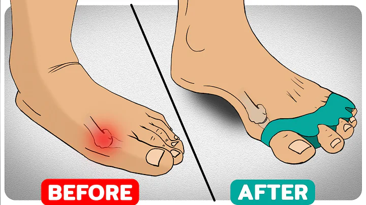 The Art of Bunion Correction - DayDayNews