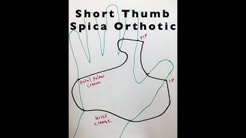 Short thumb spica Orthotic/Splint in Hand Therapy Setting