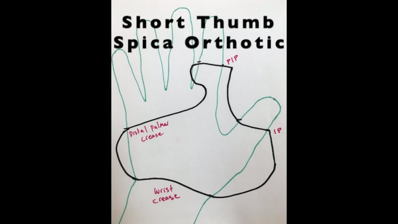 Short thumb spica Orthotic/Splint in Hand Therapy Setting - YouTube short-thumb-spica-orthotic-splint-in-hand-therapy-setting-youtube