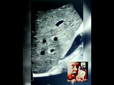 portal vein branching thrombosis ultrasound by Dr.Haissam Aref, DMS, MSc, MD ultrasound