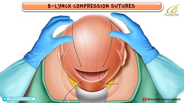 B - Lynch compression sutures Animation🏥A Lifesaver in Postpartum Hemorrhage / USMLE