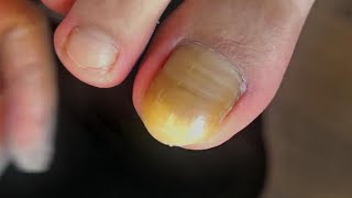 Clean up exposed long toenails 【FanYi】