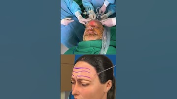 Bác sĩ Tú Dung XÓA NHĂN, CĂNG TRÁN giúp Quý ông U70 Mỹ TRẺ LÙI 20 TUỔI với Căng da mặt SMAS PRO