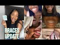 1.5 Year Braces Update: 4 Extractions, Rubber Bands, Overbite & More