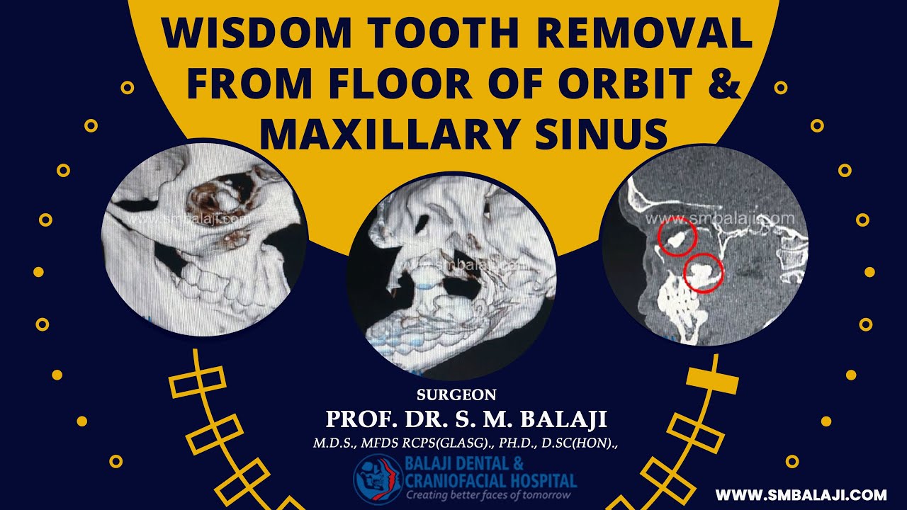 sinus tooth maxillary