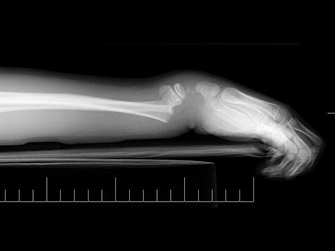 Vídeo: Fratura De Pulso Deslocada - Sintomas, Tratamento E Reabilitação