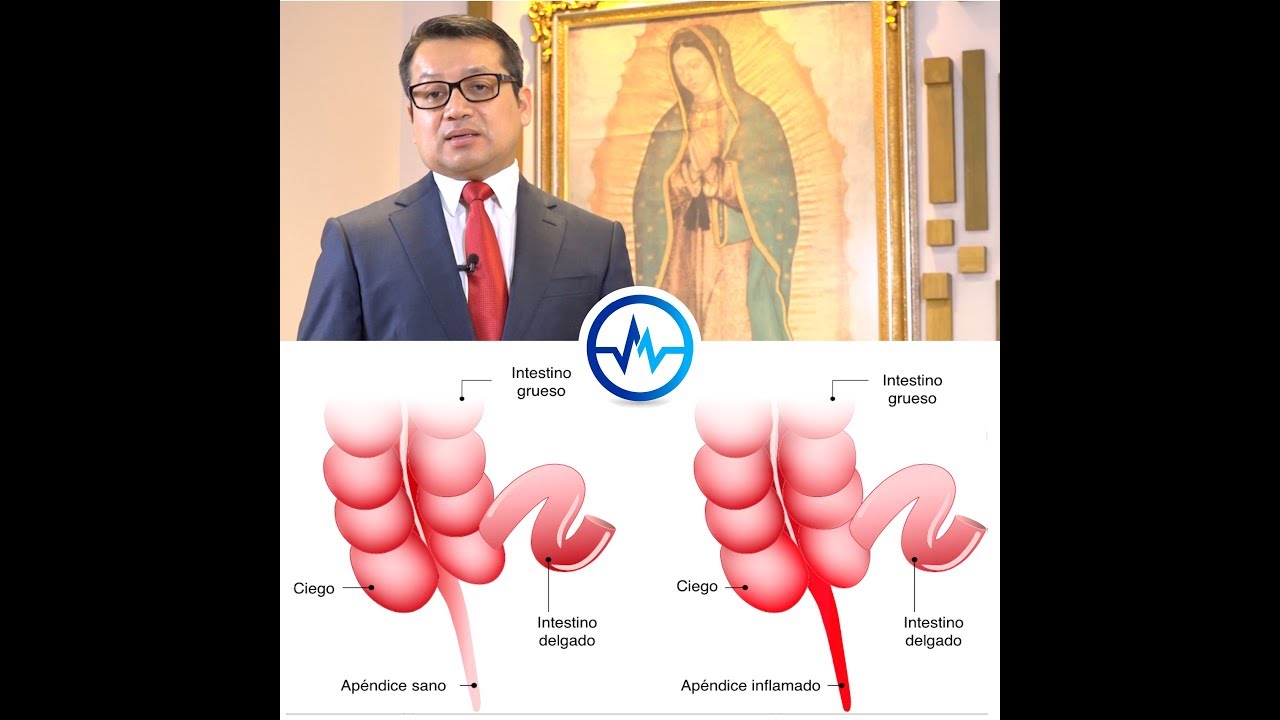 doctor vicuna APENDICITIS - DR JAVIER JAUREGUI
