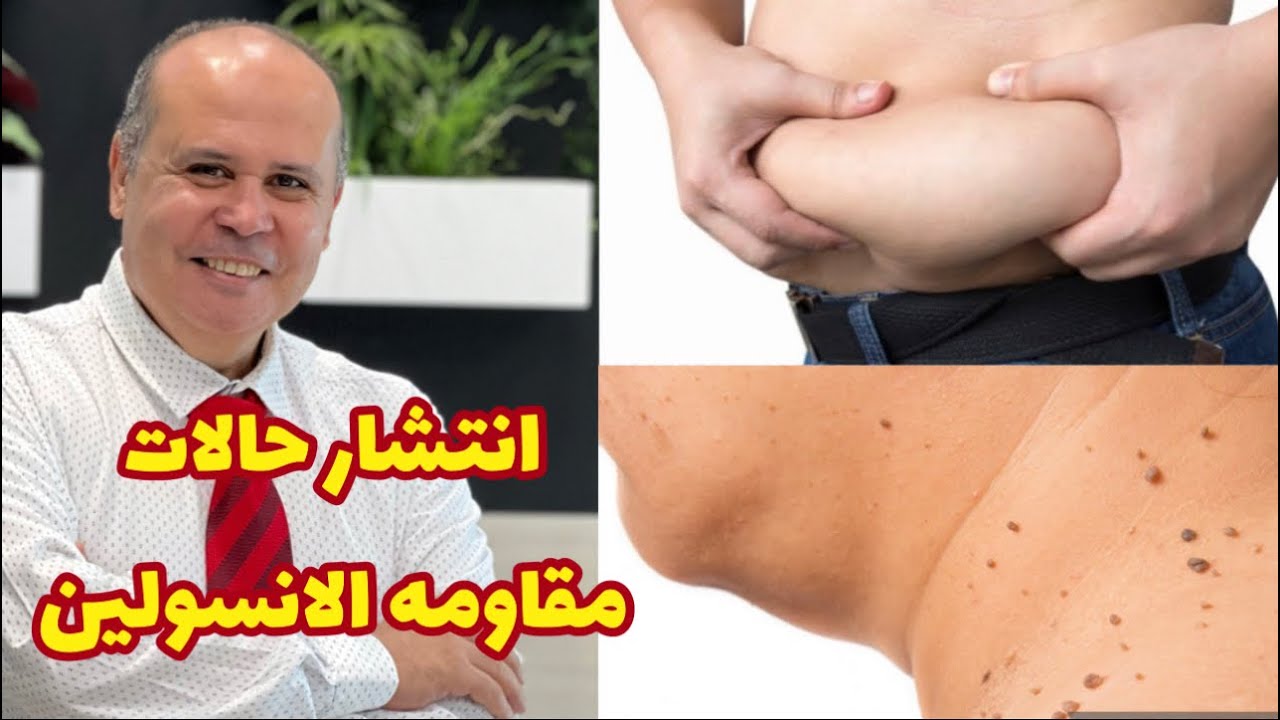 مفاجأه 👈انتشار حالات مقاومه الانسولين👈أحذروا هذه العلامات الخطيره