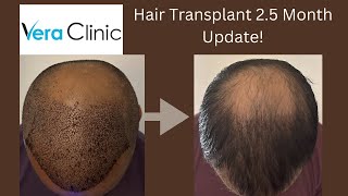 2.5 Month Update for Hair Transplant | 5200 grafts from Istanbul Turkey