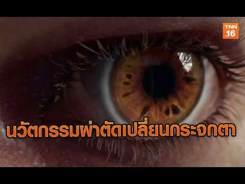 นวัตกรรมผ่าตัดเปลี่ยนกระจกตารูปแบบใหม่ | 16 มิ.ย.62 | สุขหยุดโรค