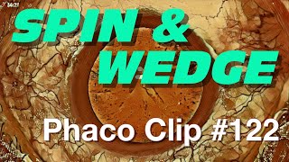 Phaco Clip #122 - SPIN & WEDGE screenshot 5