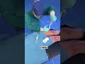 Coronary Artery Bypass Graft Surgery (3D Animation)#openheartsurgery #openheartsurgerysurvivor